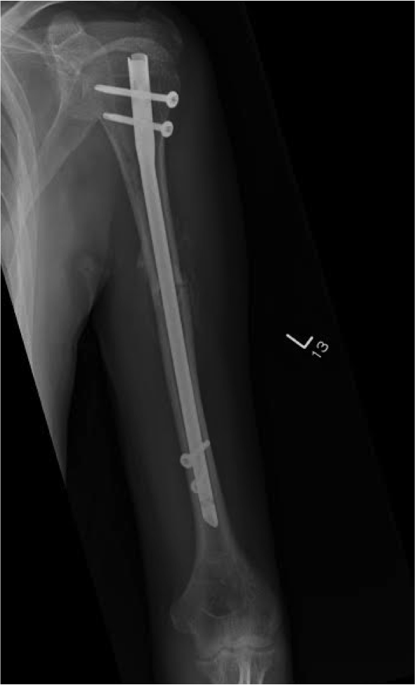 Humeral Shaft Fracture Fixation